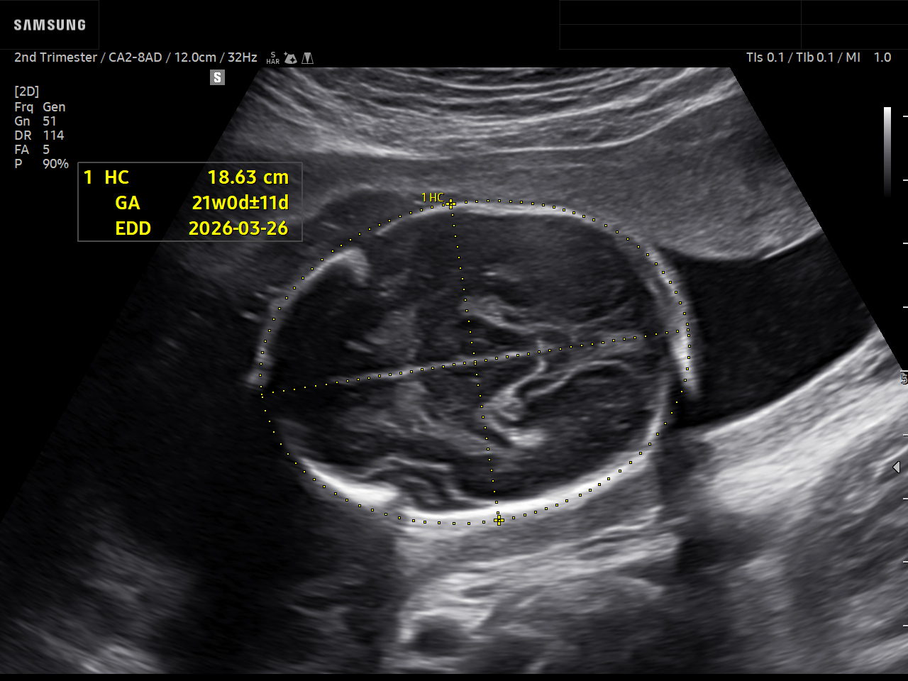 OB ultrasound image of Fetal Brain using ViewAssist™ feature – Samsung EVO Q10