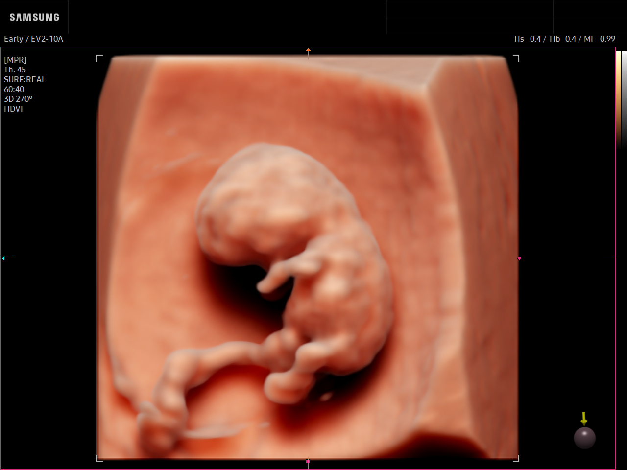 OB ultrasound image of First-trimester Fetus using RealisticVue™ feature – Samsung EVO Q10