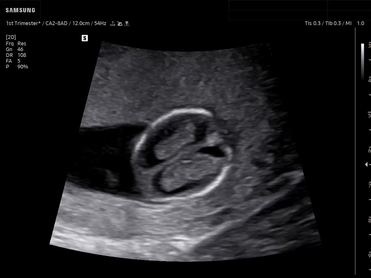 OB ultrasound image of First-trimester fetal brain - Samsung EVO Q10