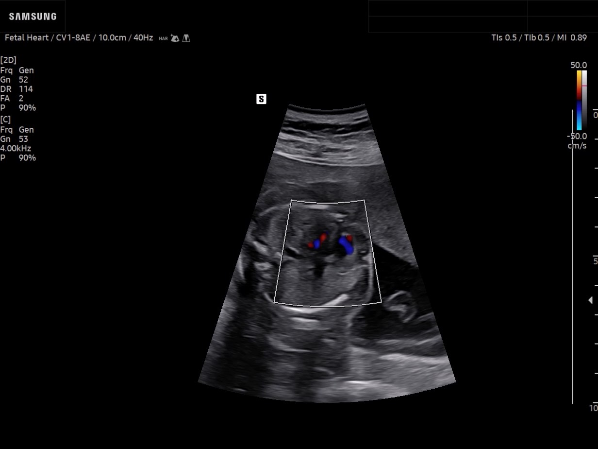 OB ultrasound image of First-trimester fetal heart in Color - Samsung EVO Q10