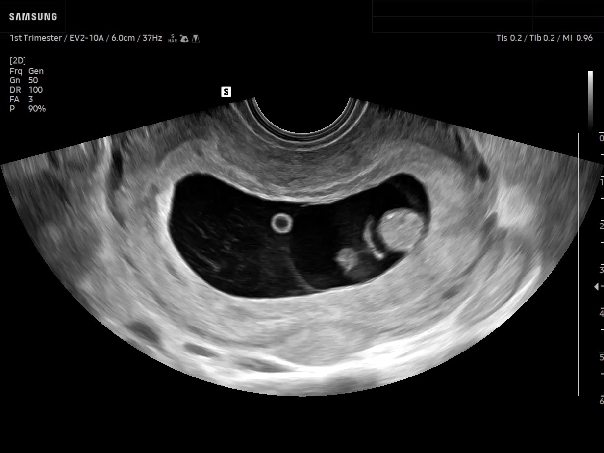OB ultrasound image of First-trimester Fetus in 2D - Samsung EVO Q10