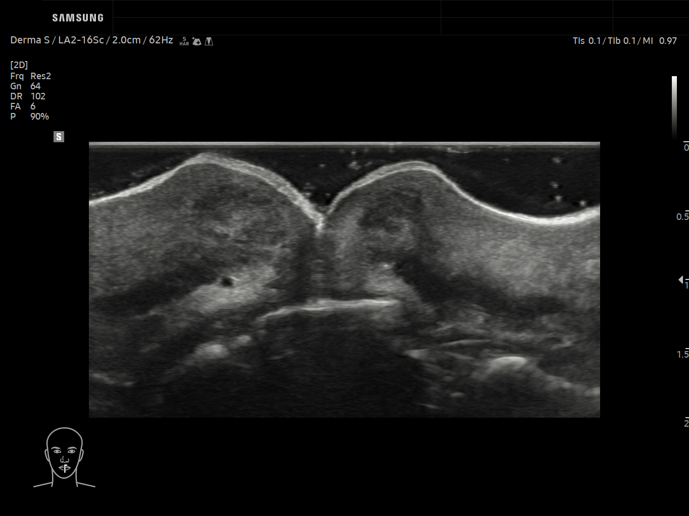 Derma ultrasound image of Lips (labium superius and inferius) in 2D – Samsung EVO Q10