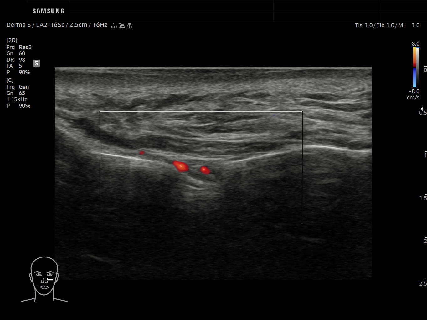 Derma ultrasound image of Infraorbial artery using LumiFlow™ feature – Samsung EVO Q10