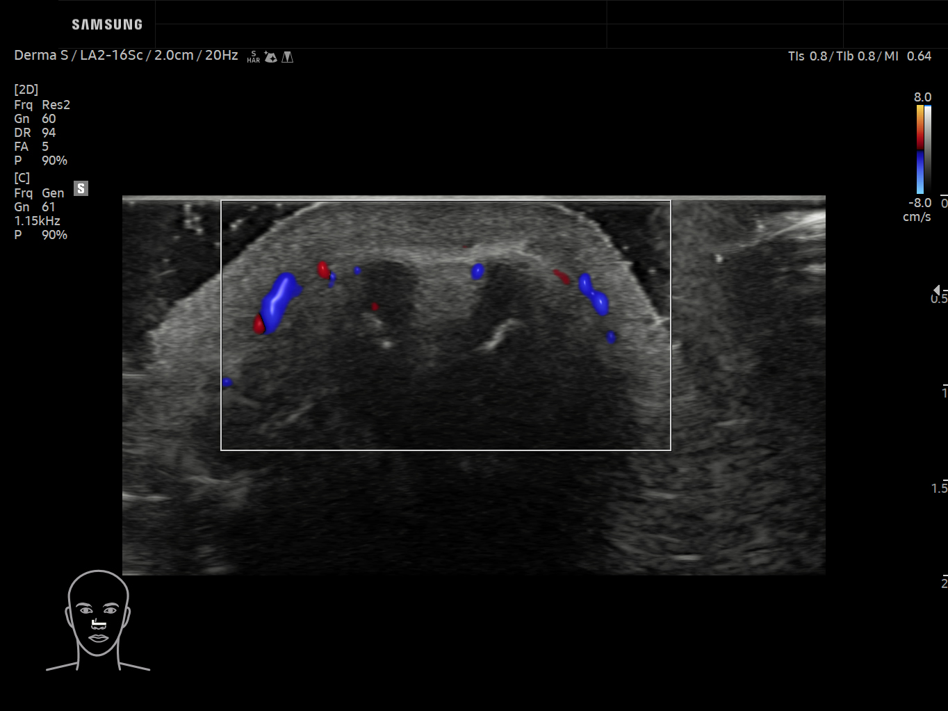 Derma ultrasound image of Nose using LumiFlow™ feature – Samsung EVO Q10