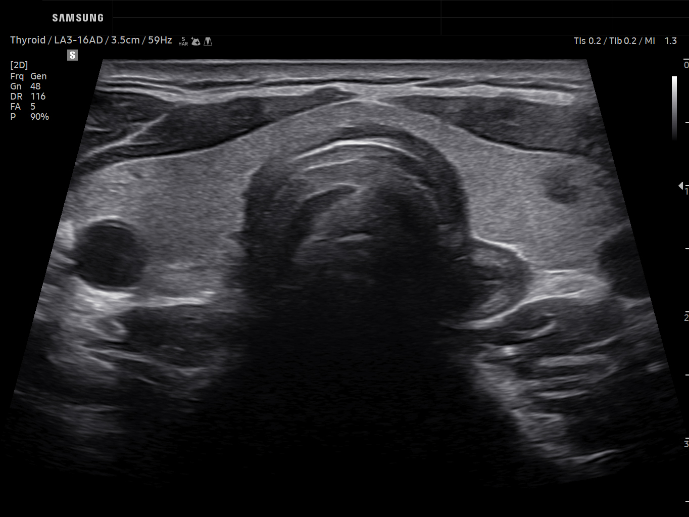 Thyroid ultrasound image of Thyroid Nodule with Trapezoid Imaging – Samsung EVO Q10