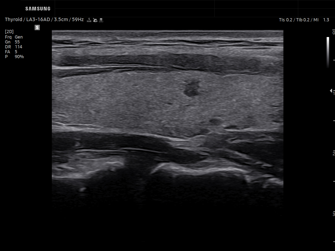 Thyroid ultrasound image of Thyroid Nodule Longitudinal View – Samsung EVO Q10