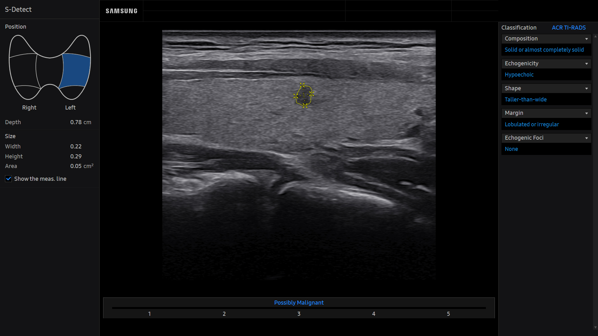Thyroid ultrasound image of Thyroid Nodule using S-Detect for Thyroid™ feature – Samsung Medison Q10