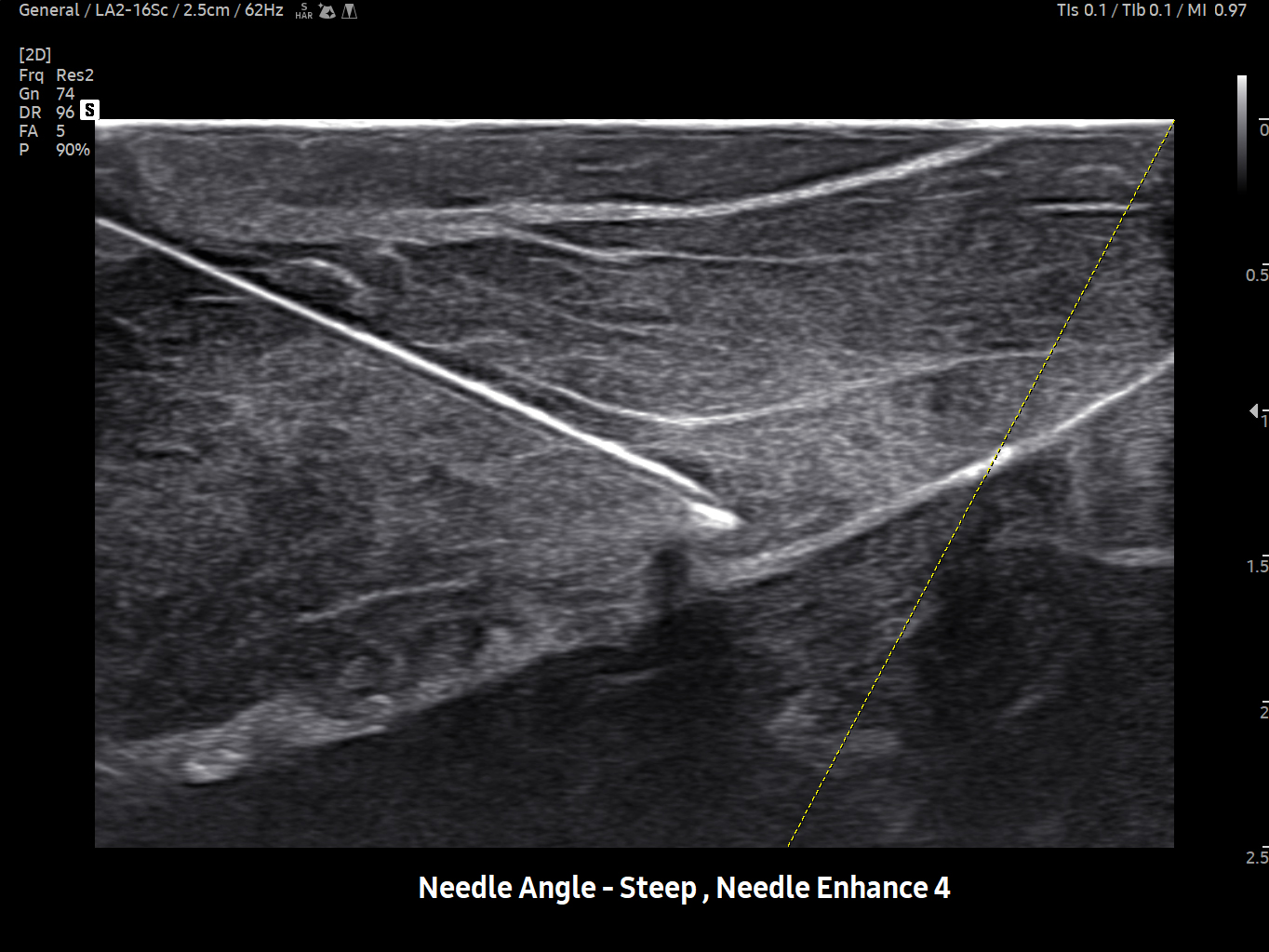 MSK ultrasound image using NeedleMate+ feature – Samsung EVO Q10