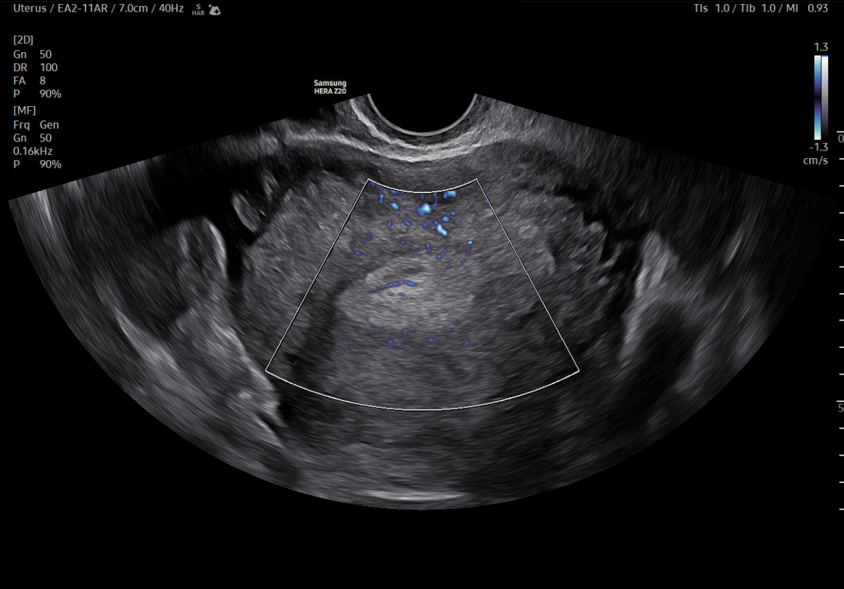 Uterus visualization with MV-Flow on Samsung Medison HERA Z20