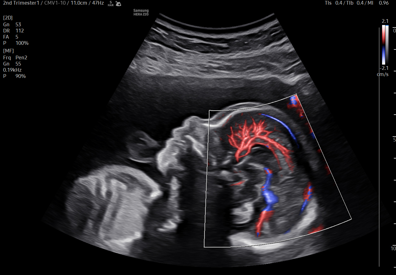 Fetal brain visualization with MV Flow-Max on Samsung HERA Z20