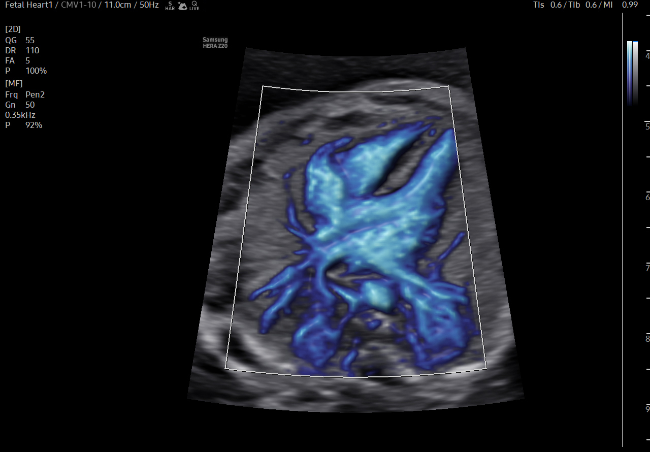 Fetal heart visualization with MV-Flow Max on Samsung HERA Z20
