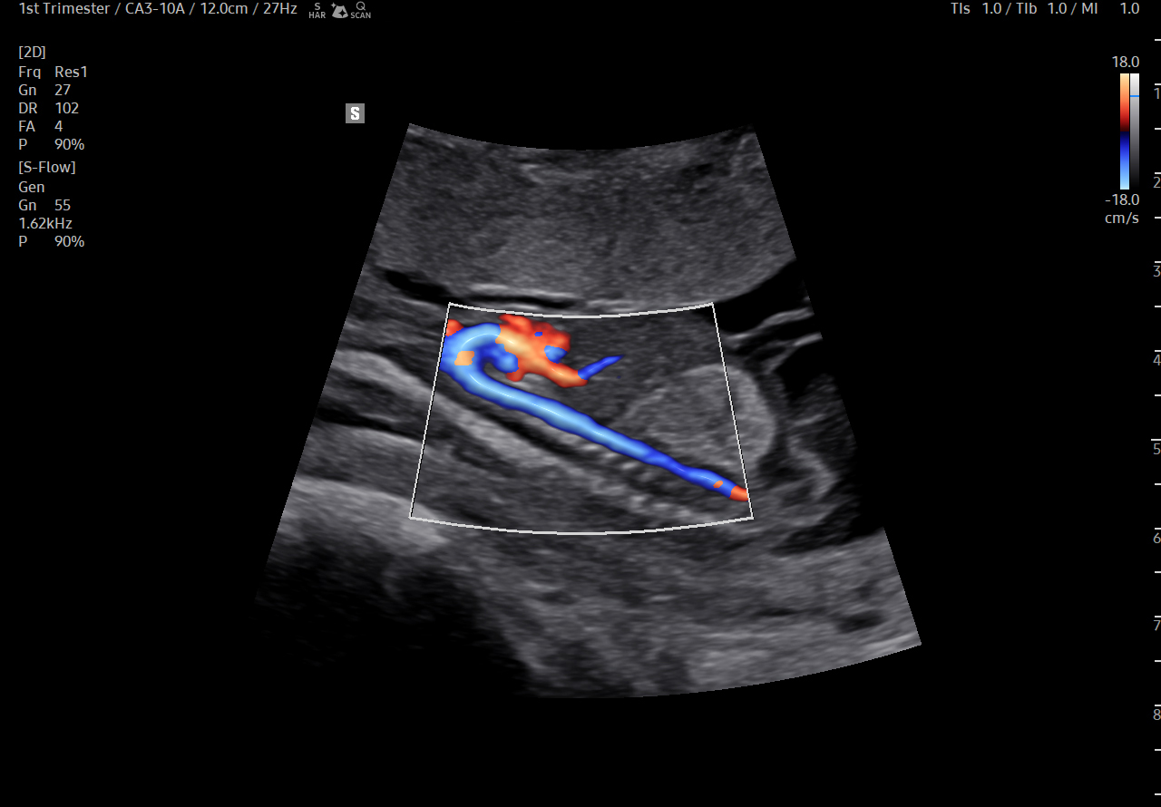 1st trimester arch view visualization with LumiFlow on Samsung Medison HERA Z20