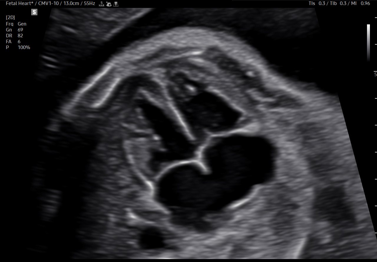 Fetal heart visualization with Luminant On on Samsung HERA Z20