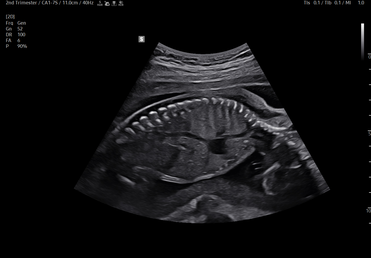 Fetal heart visualization with Luminant On on Samsung HERA Z20