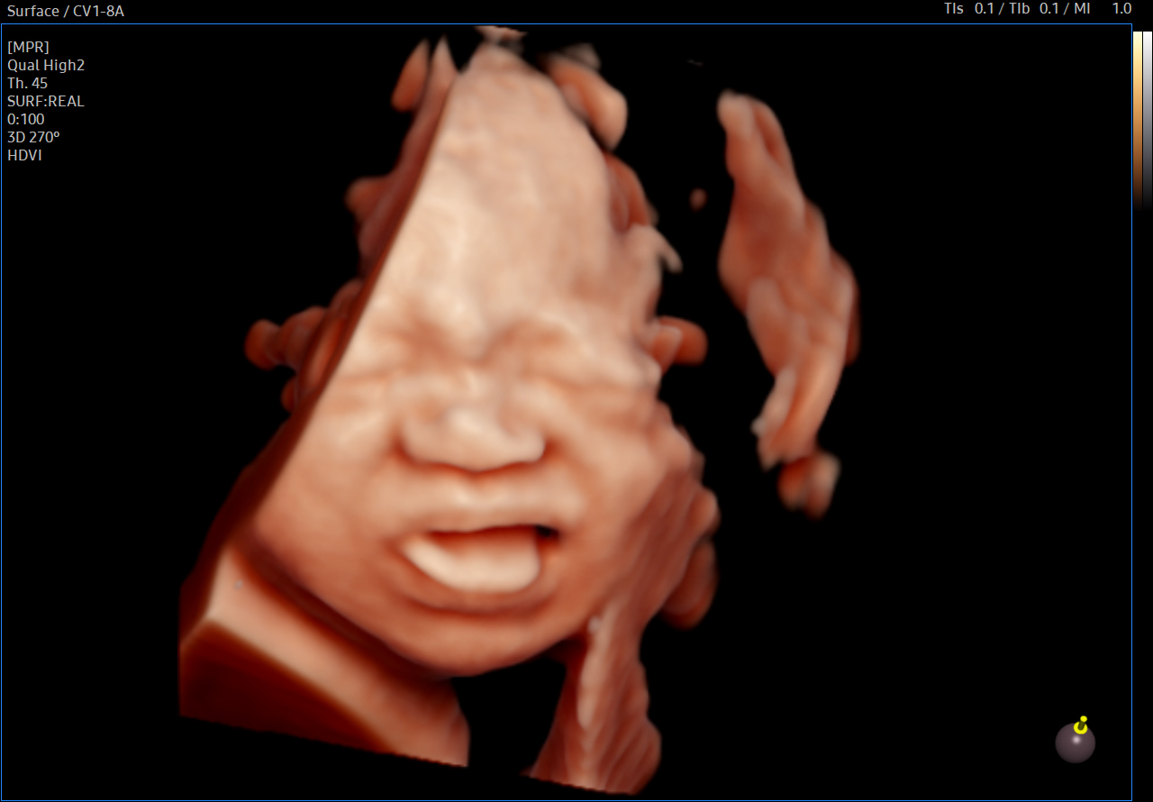 Fetal face visualization with RealisticVue on Samsung HERA Z20