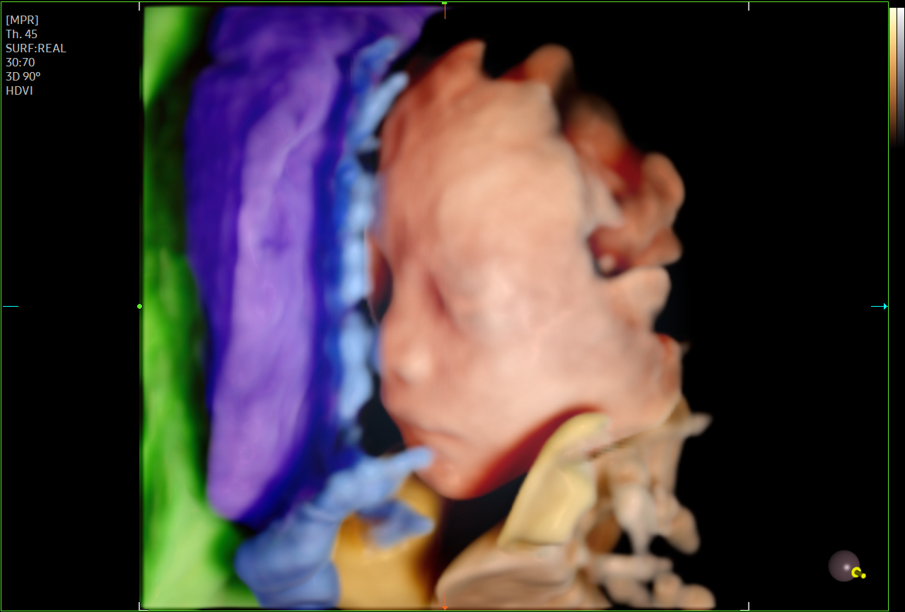 Fetal spine visualization with Crystalvue on Samsung HERA Z20