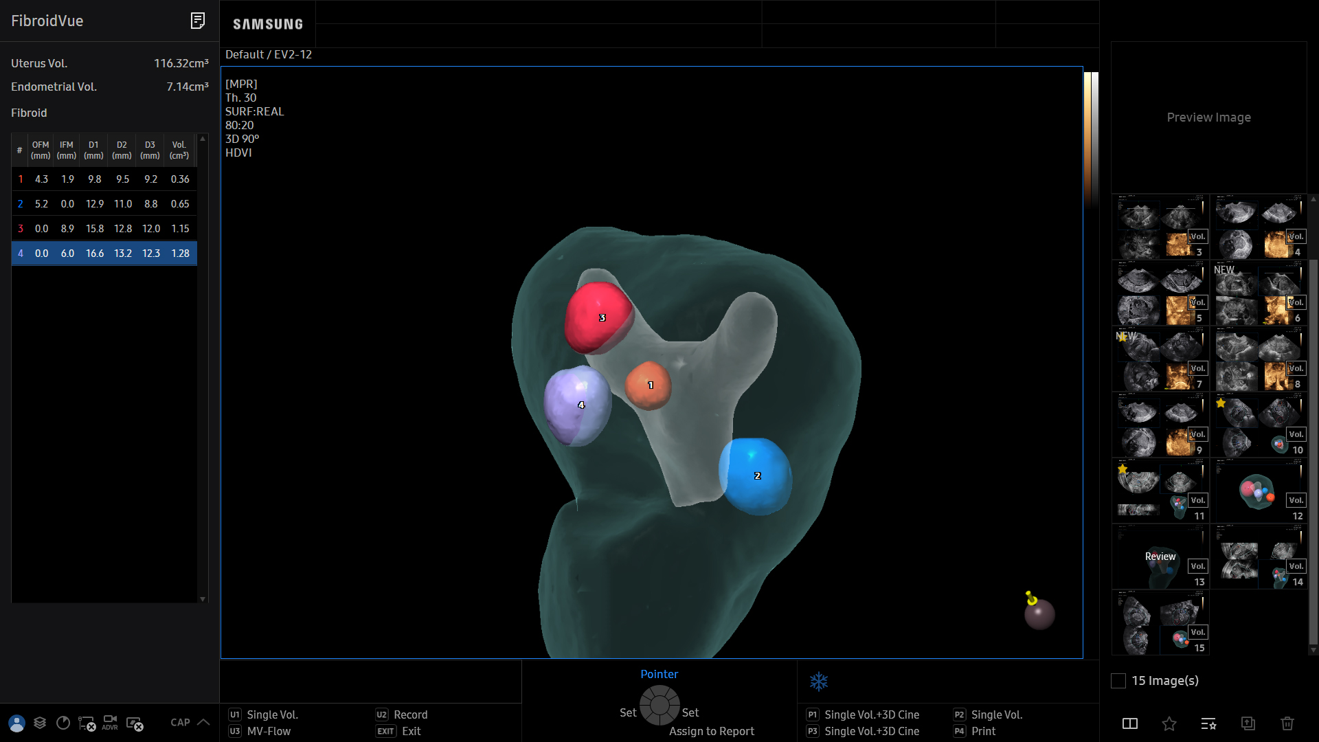 Fibroid visualization with FibroidVue on Samsung HERA Z20