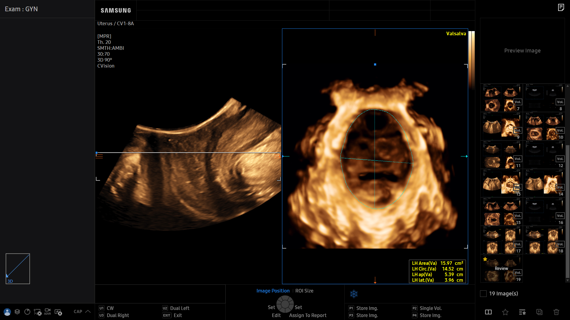 Uteus visualization with PelvicAssist on Samsung HERA Z20