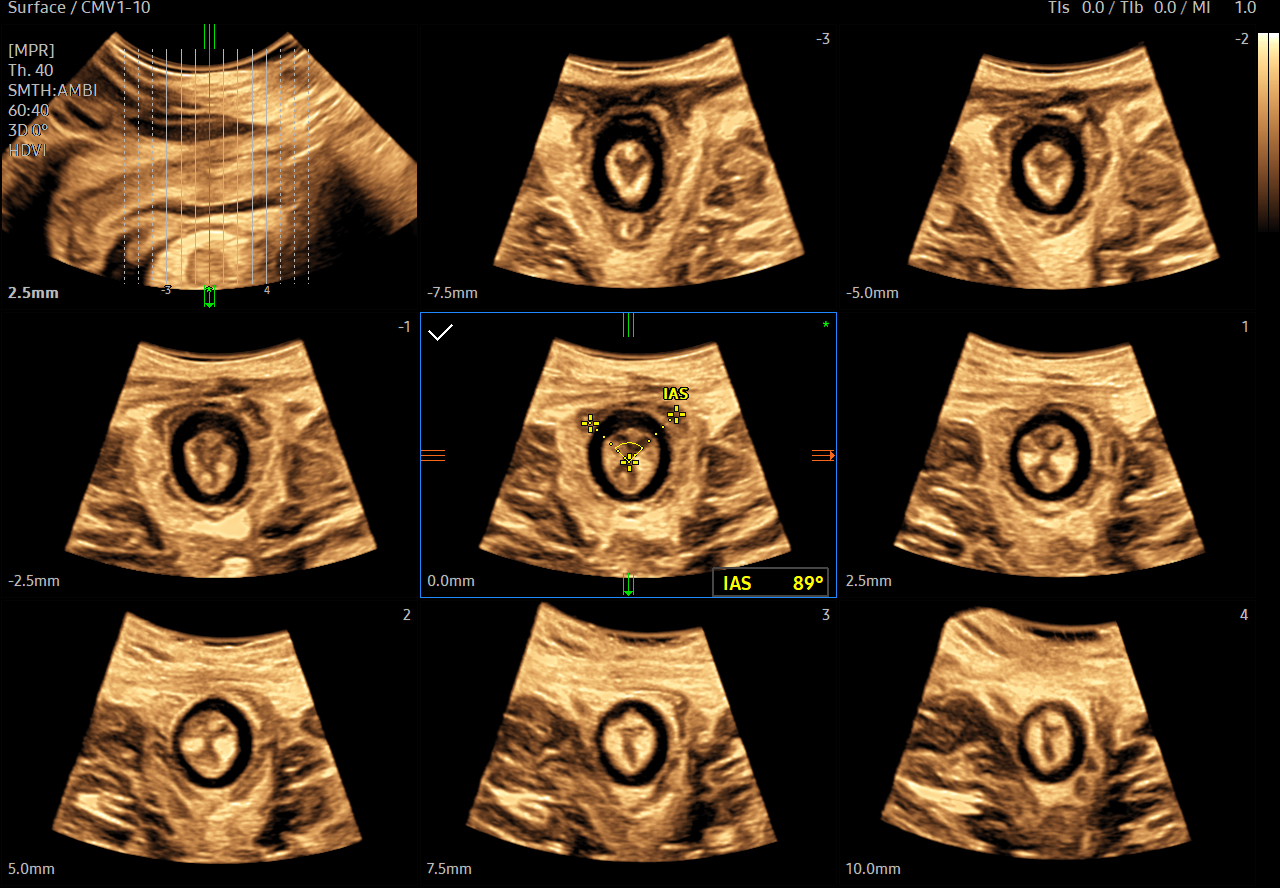 Analsphincter visualization on Samsung HERA Z20