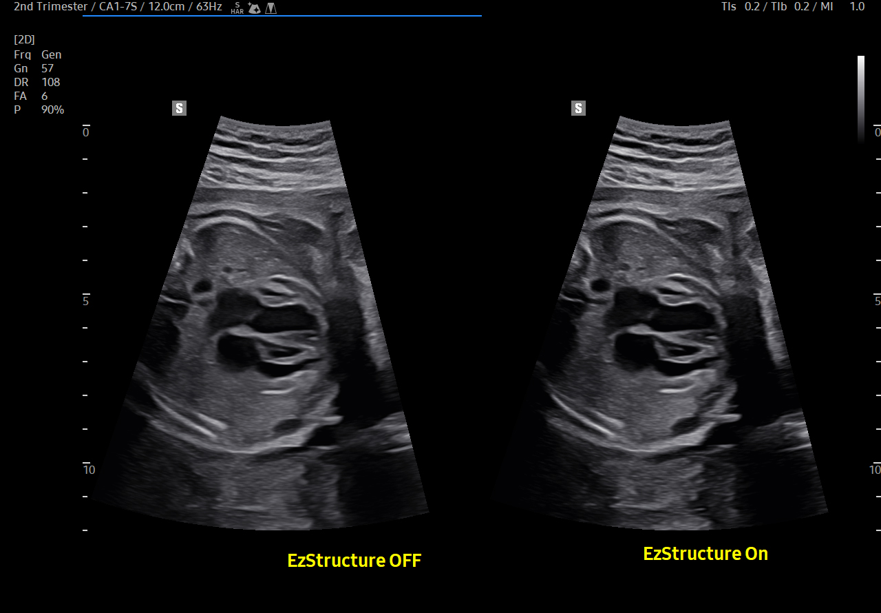 Fetal heart visualization with EzStructure_Off, On on Samsung HERA Z20