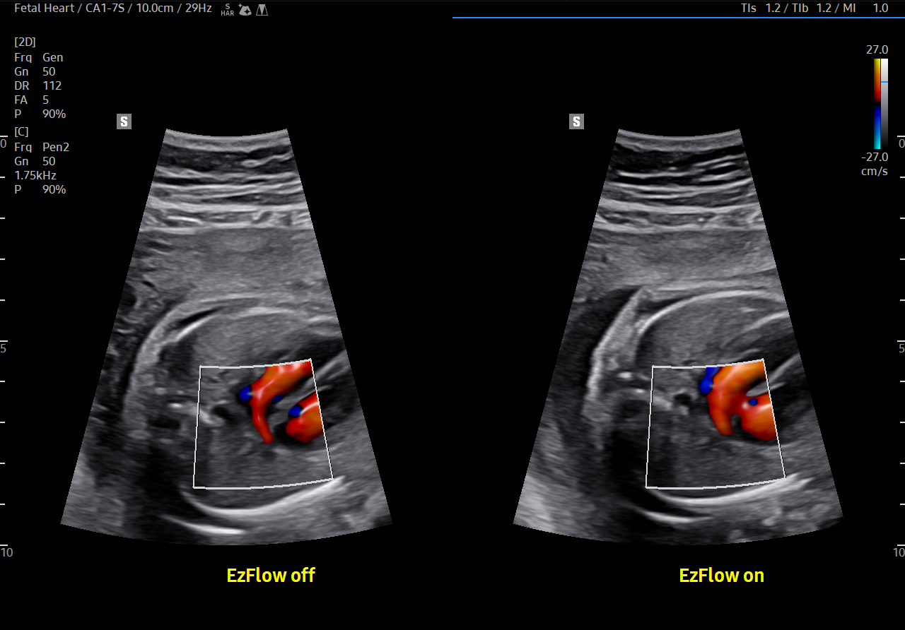 Fetal heart visualization with EzFlow_Off oN on Samsung HERA Z20