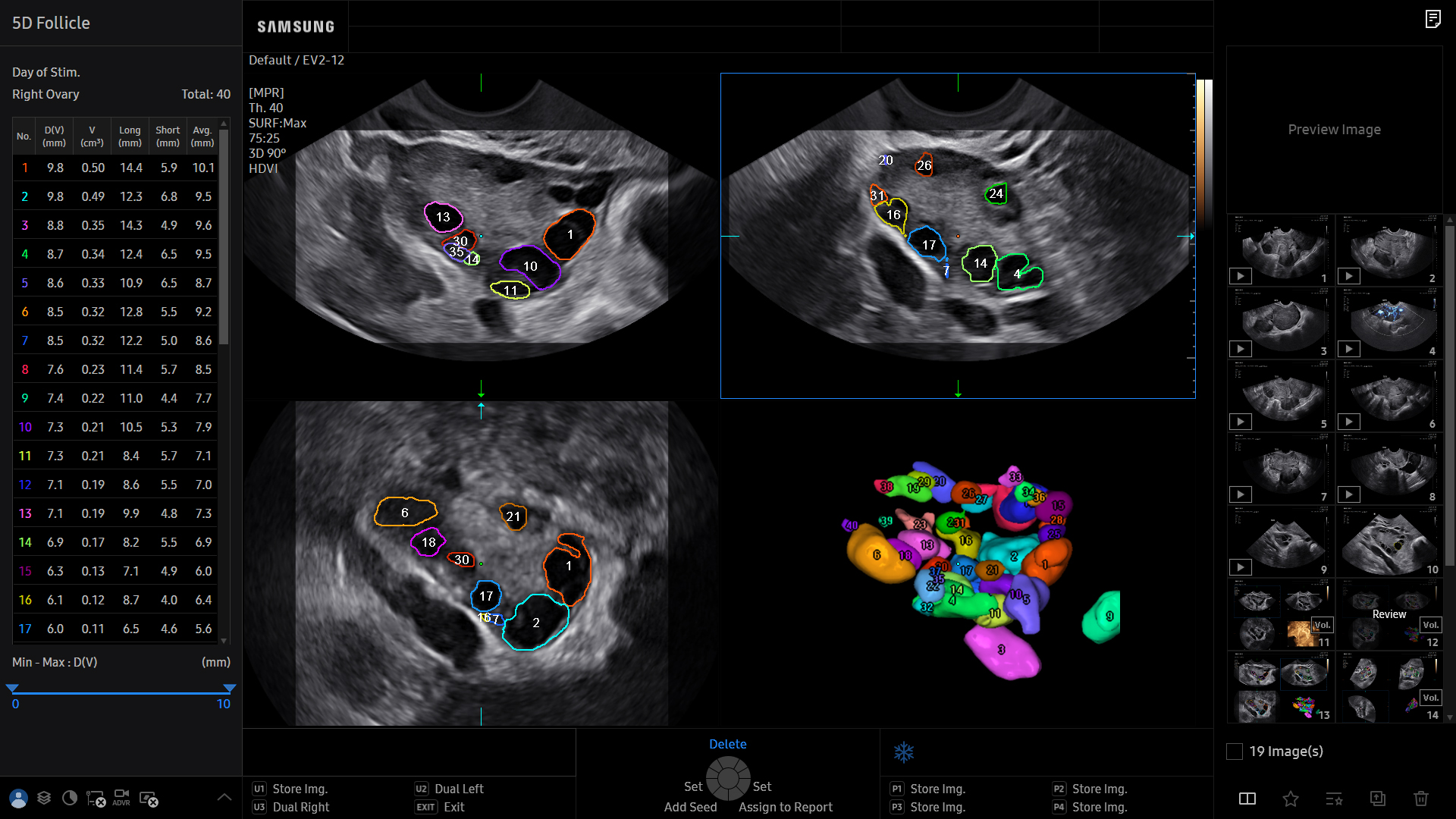 Follicle visualization with 5D Follicle on Samsung HERA Z20