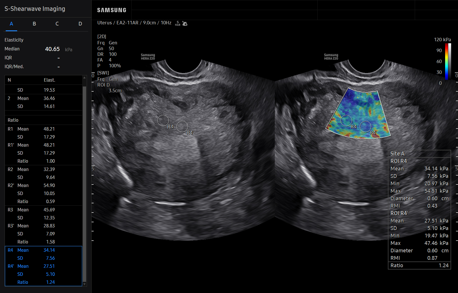 Uterus visualization with S-Shearwave OFF On on Samsung HERA Z20
