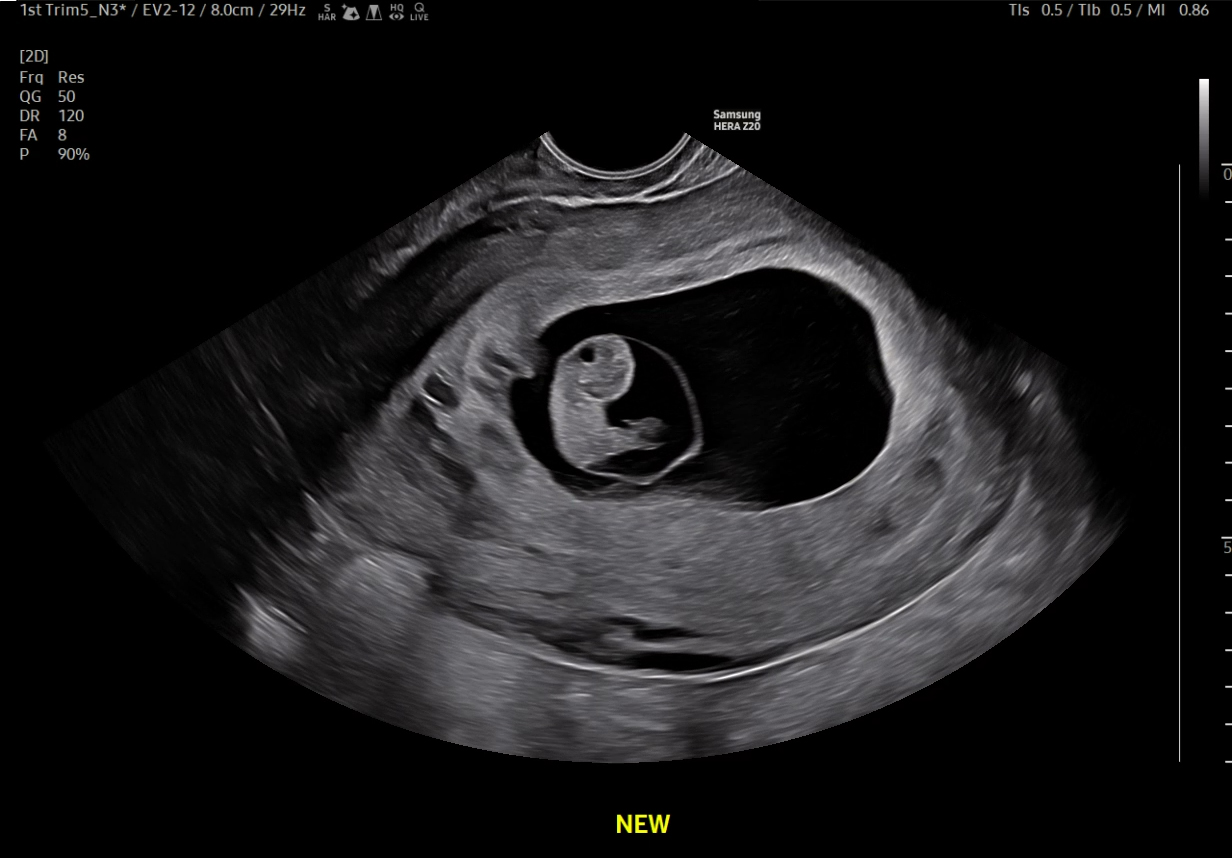 1st trimester fetus with 3rd Harmonic technology visualization on Samsung HERA Z20