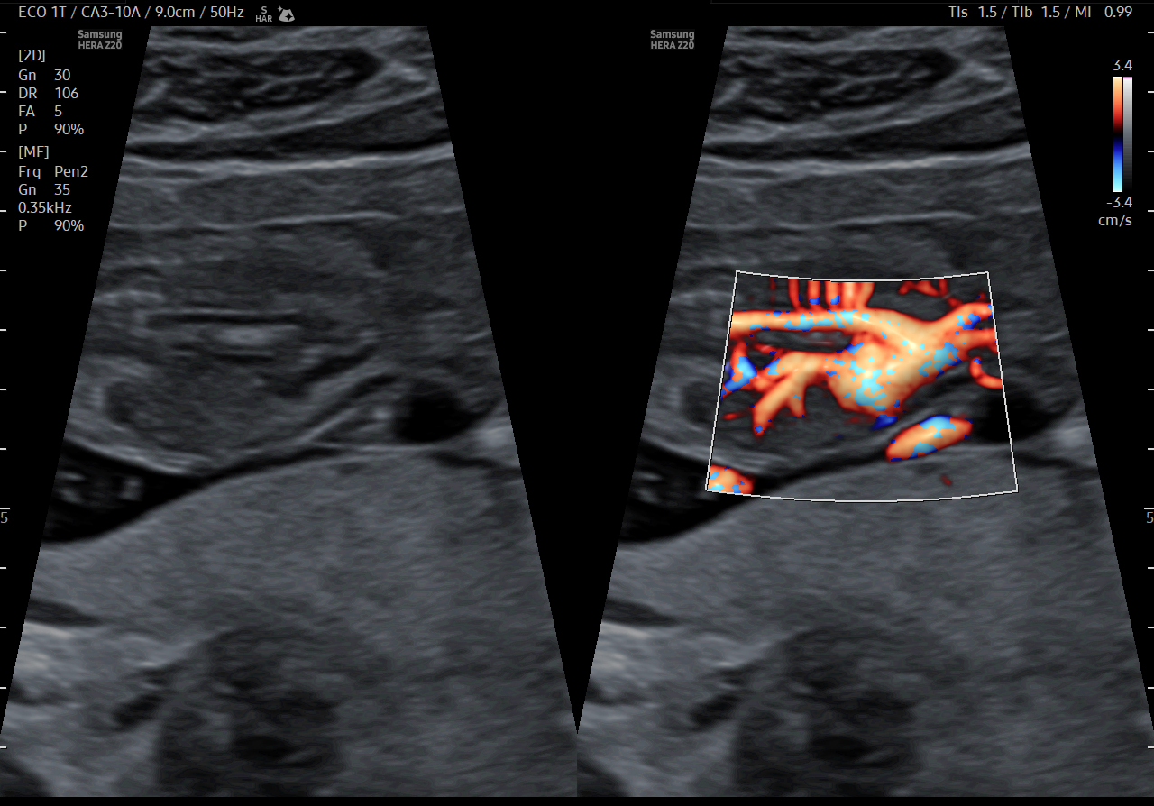 Early Fetal heart visualization with MV-Flow on Samsung HERA Z20