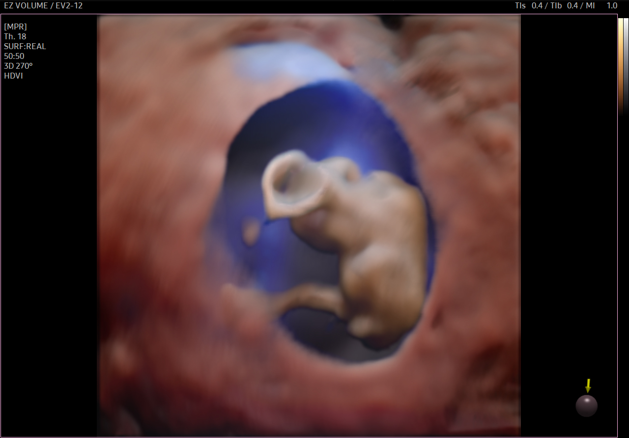 Early fetus visualization with EzVolume on Samsung HERA Z20
