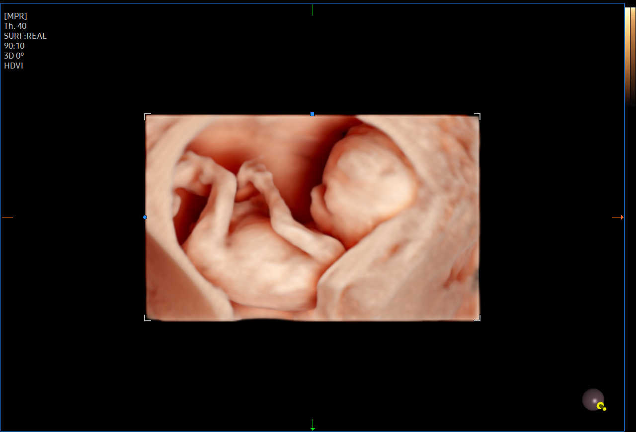 Fetus 1st Trimester visualization with RealisticVue on Samsung HERA Z20