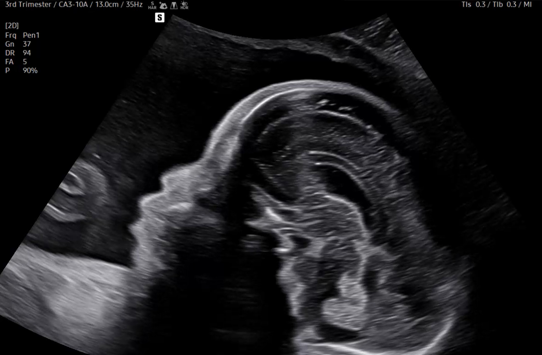 3rd trimester fetal brain visualization on Samsung HERA Z20