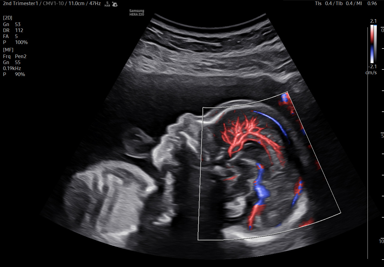 Pericallosal artery 2nd Trimester visualization with MV-Flow Max on Samsung HERA Z20