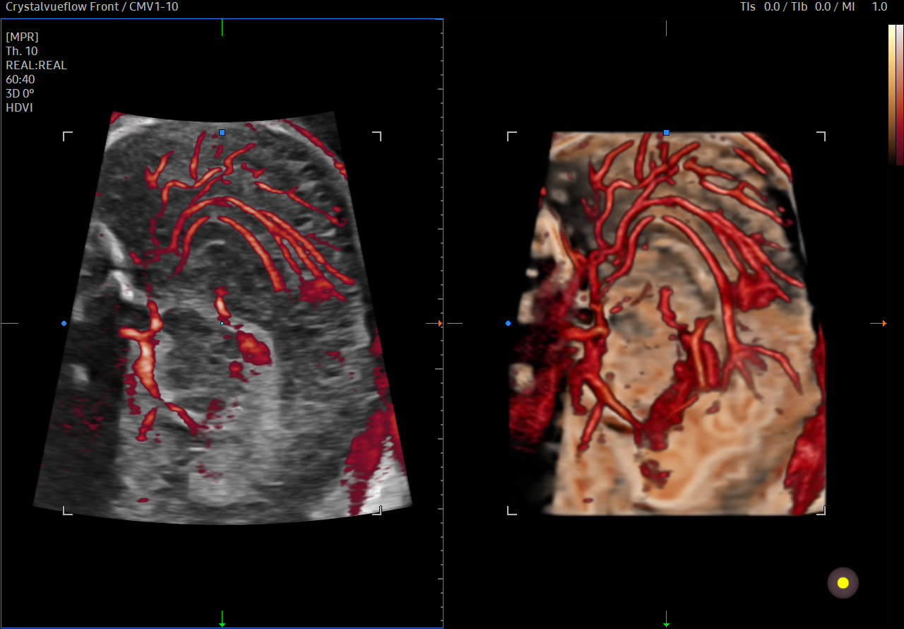 Pericallosal artery visualization with MV-Flow 3D on Samsung HERA Z20