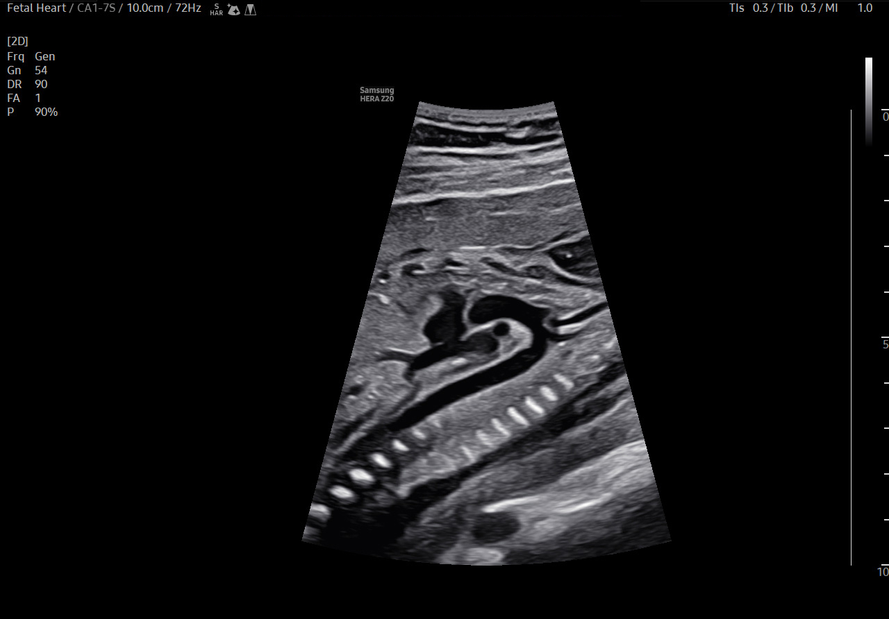 Fetal heart visualization with Aortic Arch View on Samsung HERA Z20