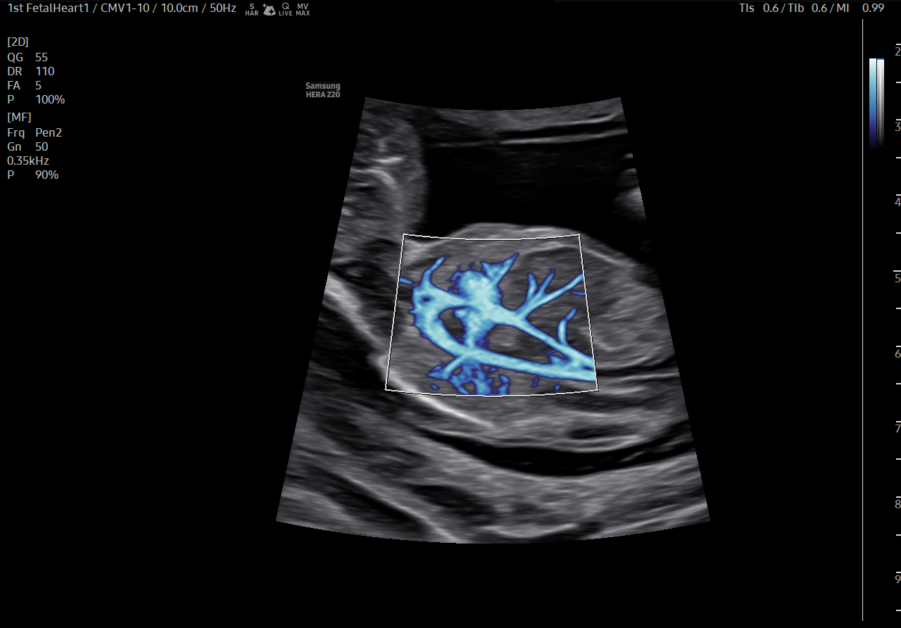 Early FH visualization with MV-Flow Max on Samsung HERA Z20