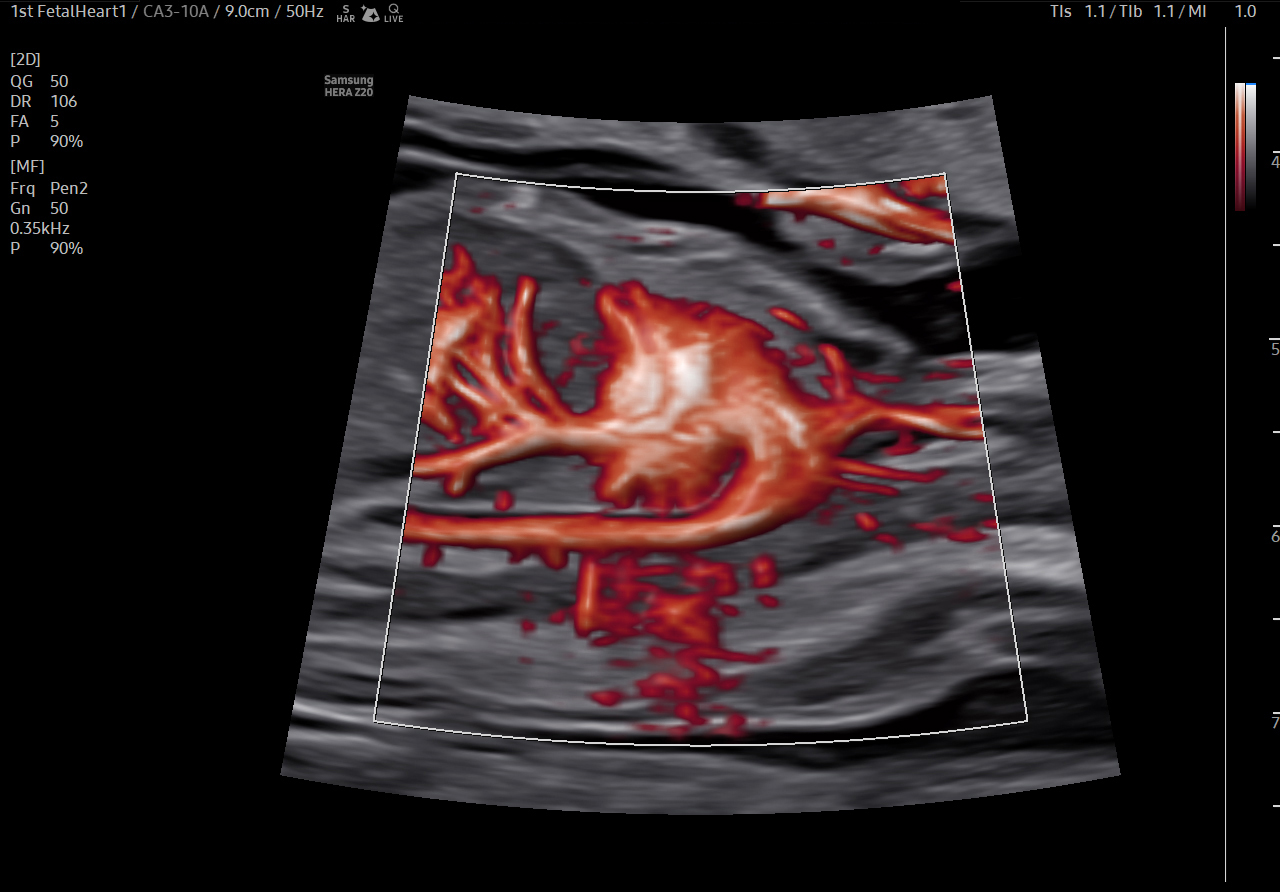 Fetal heart visualization with MV-Flow Max ™¹ on Samsung HERA Z20