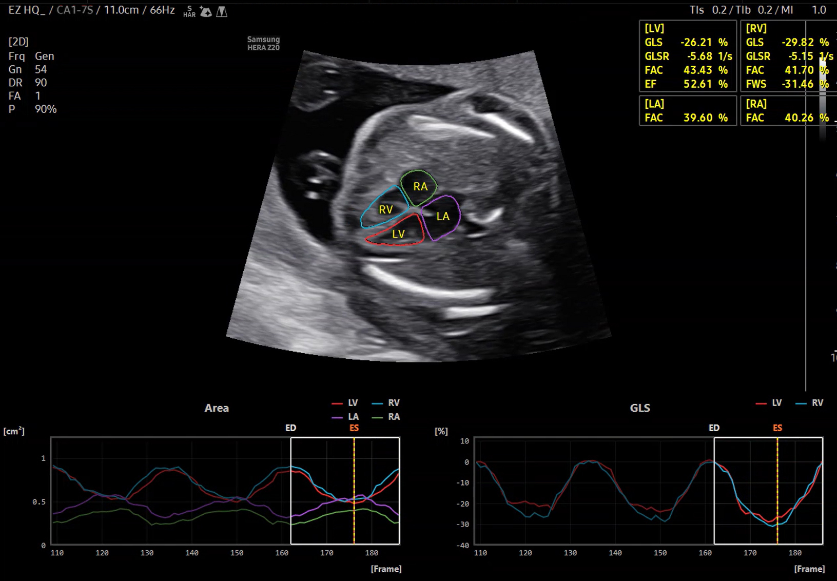Fetal heart visualization with EzHQ on Samsung HERA Z20