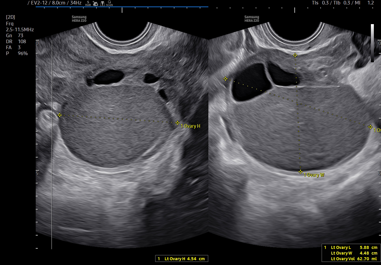 Endometrioma visualization on Samsung HERA Z20