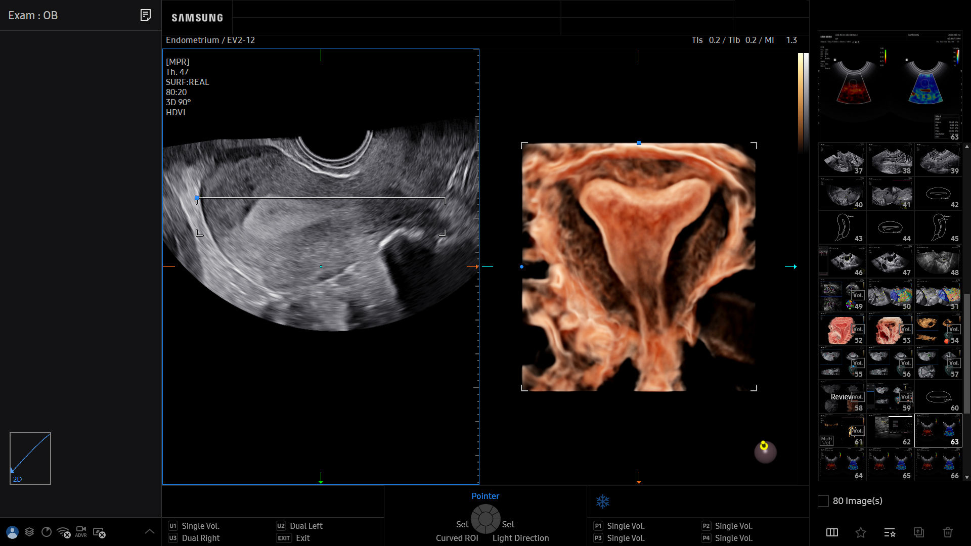 Uterus visualization with CrystalVue on Samsung HERA Z20