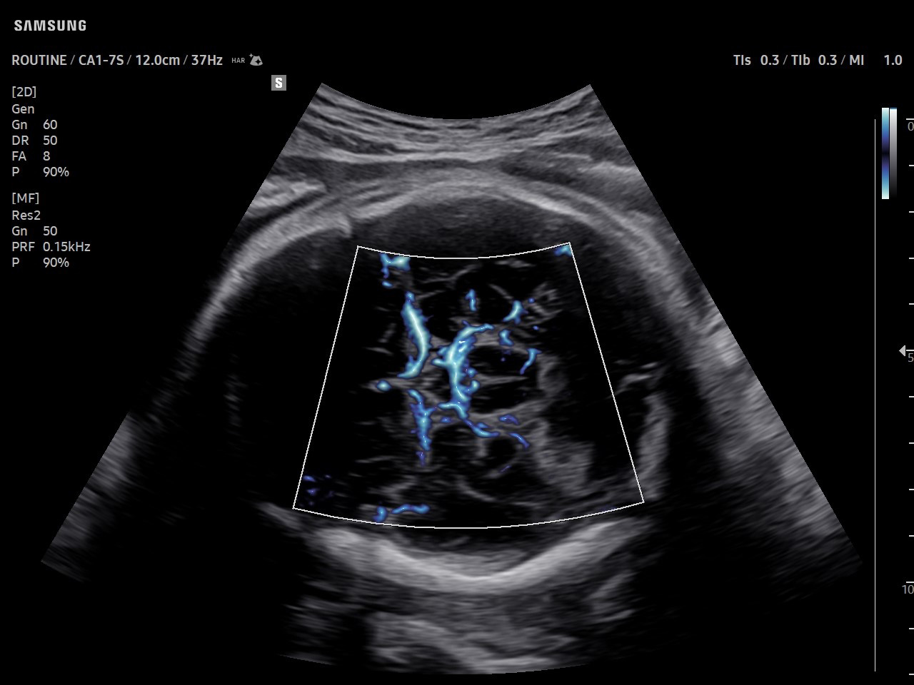 OB Fetal Brain visualization with MV-Flow™ on Samsung V8