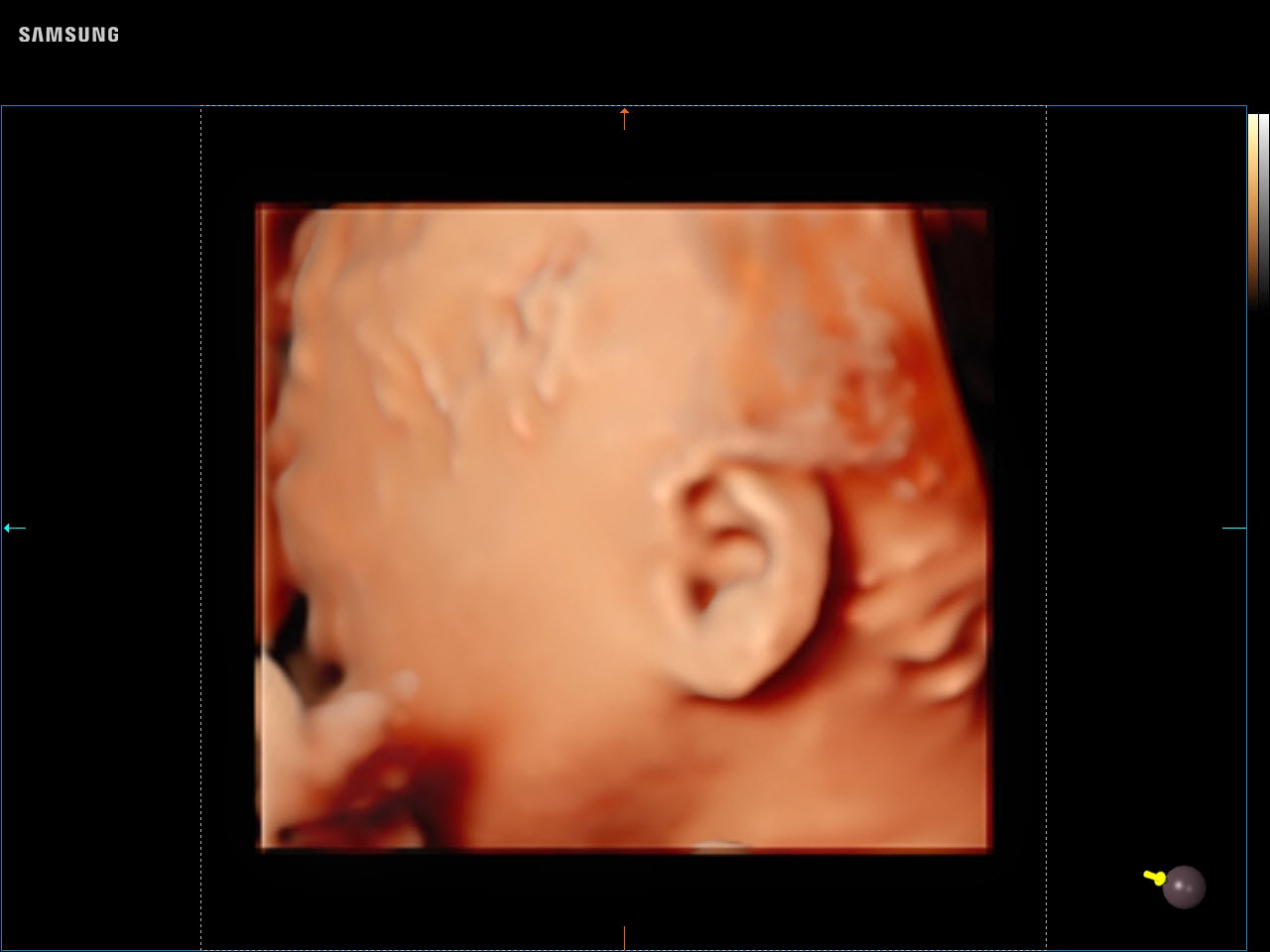 OB Fetal Ear visualization with RealisticVue™ on Samsung V8
