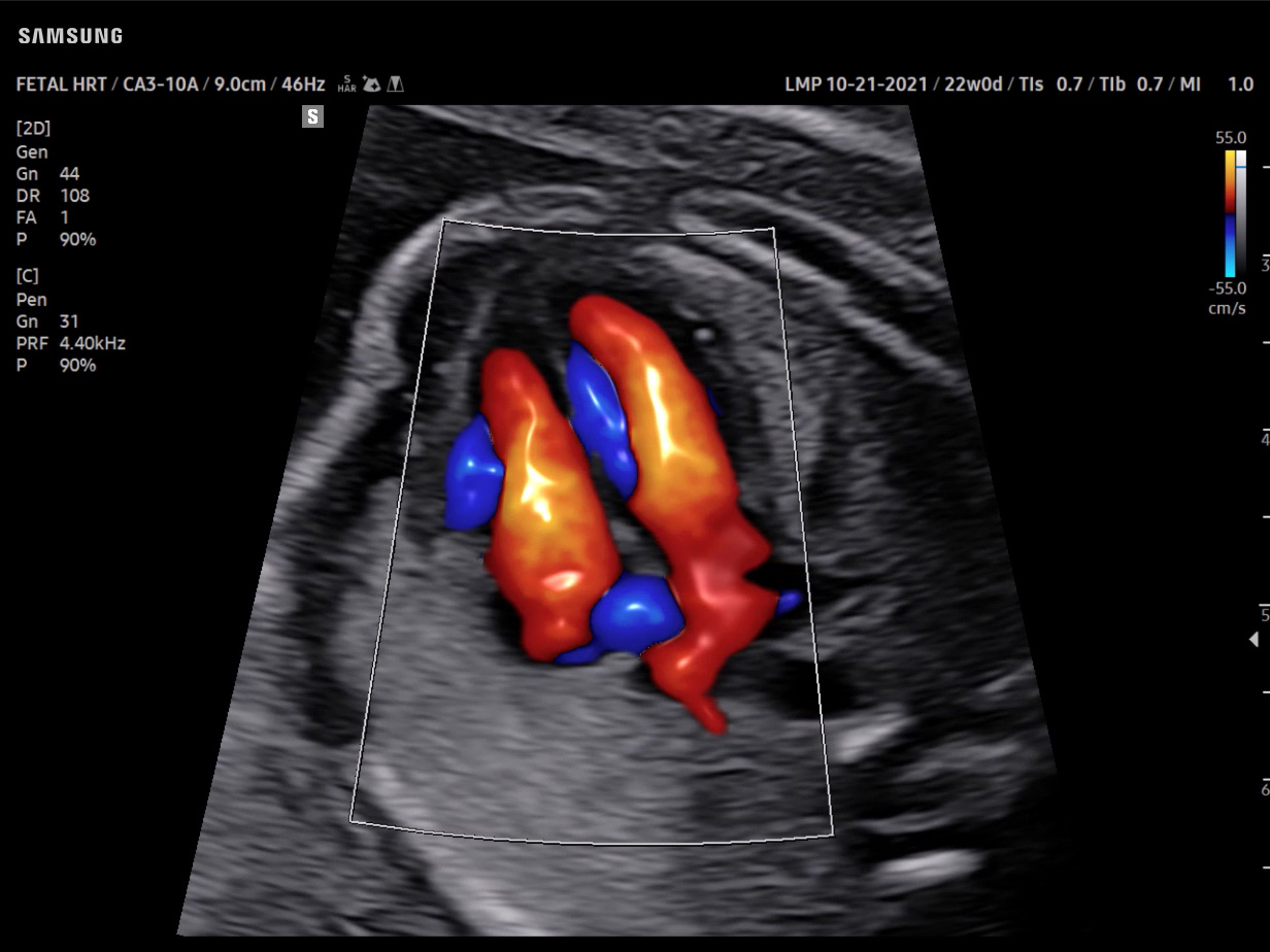 OB Fetal Heart visualization with LumiFlow™ on Samsung V8