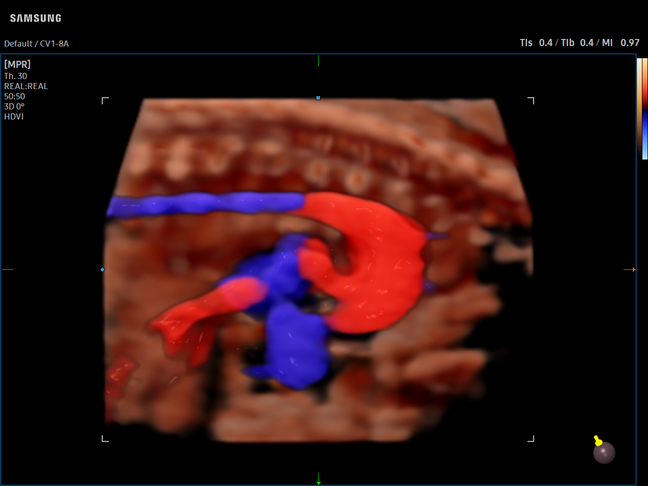 OB Fetal Heart visualization with CrystalVue™ on Samsung V8