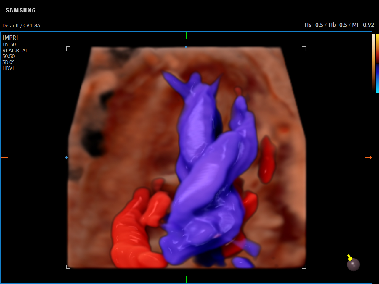 OB Fetal Heart visualization with CrystalVue™ Flow 2 on Samsung V8