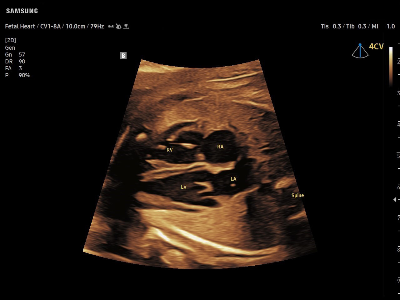 OB Fetal Heart visualization with ViewAssist on Samsung V8