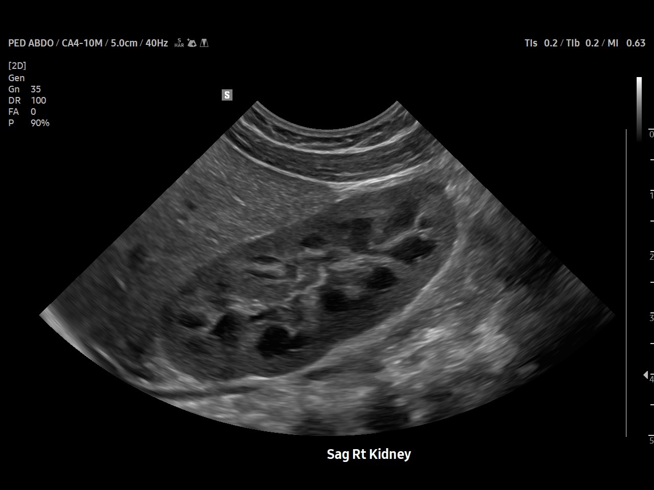 Pediatric Kidney visualization on Samsung V8