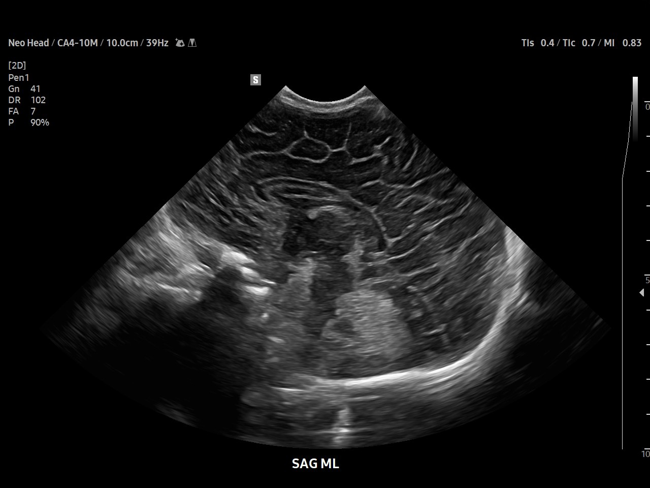 Pediatric Neonatal Head visualization with Sagittal view on Samsung V8