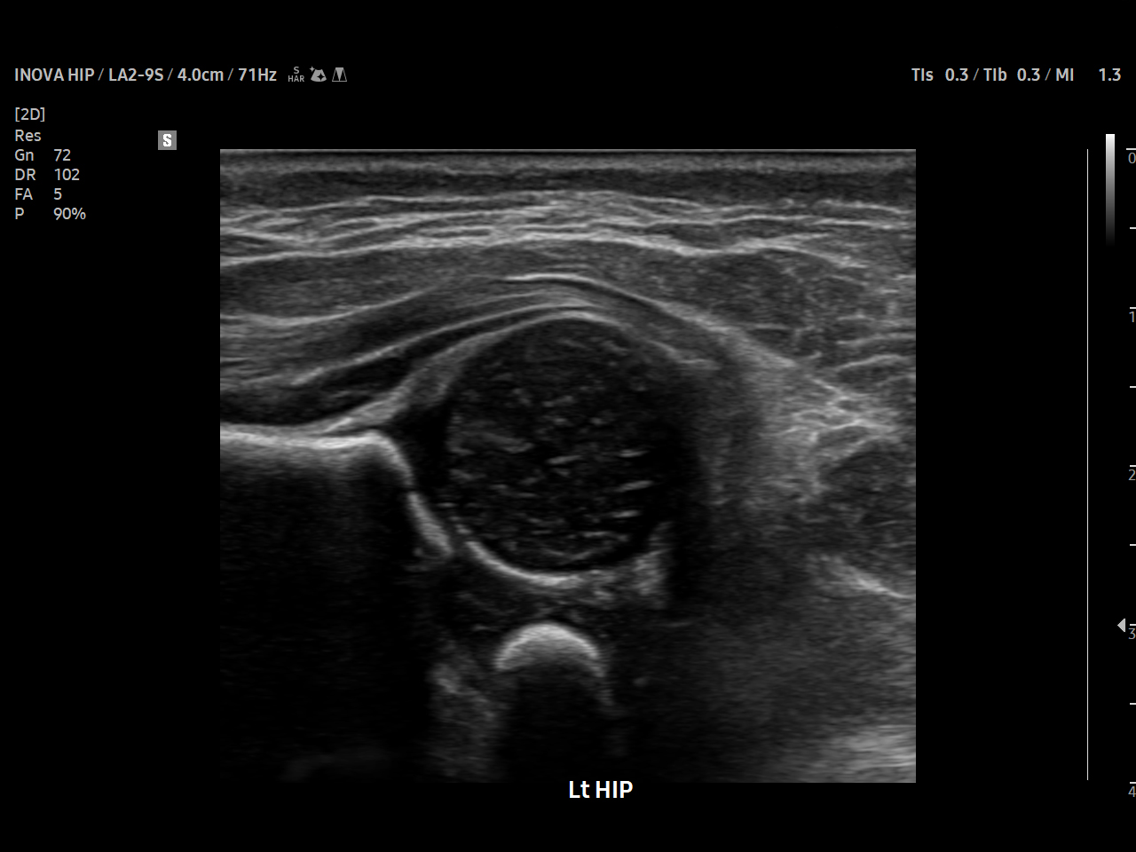 Pediatric Pediatric Hip visualization on Samsung V8
