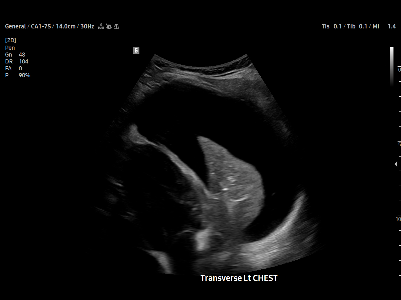 Pediatric Pericardial effusion visualization on Samsung V8